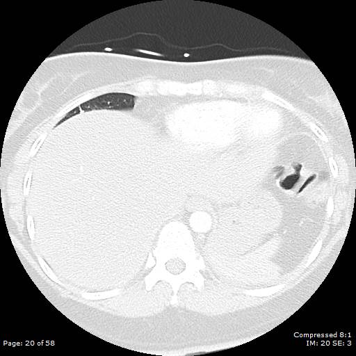 Bilateral pulmonary emboli with Hampton hump sign (Radiopaedia 54070-60246 Axial lung window 20).jpg