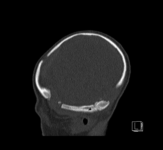 Bilateral subdural hemorrhage and parietal skull fracture (Radiopaedia 26058-26192 Sagittal bone window 13).png