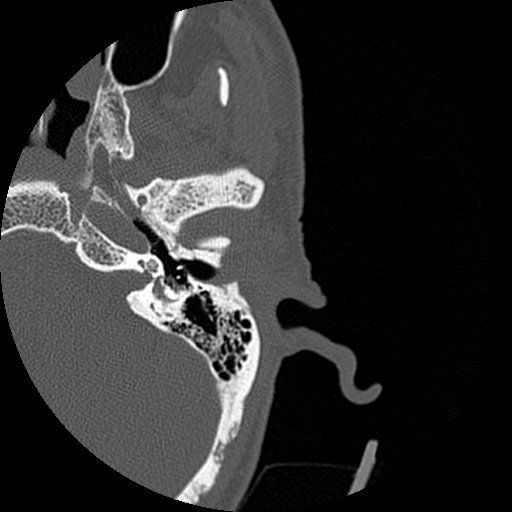 Bilateral temporal bone fractures (Radiopaedia 29482-29970 D 72).jpg