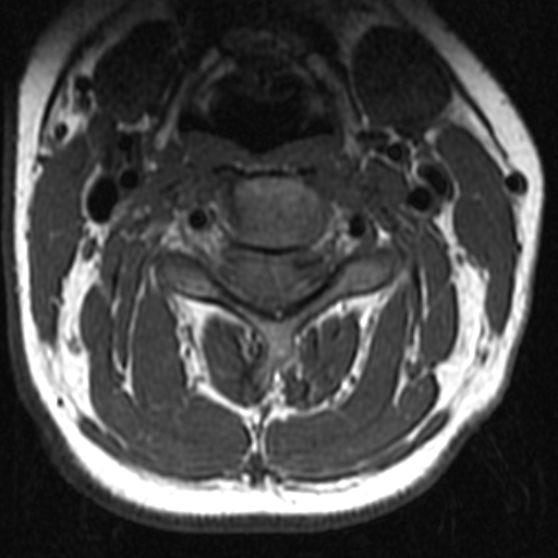 File:Bilateral tortuous vertebral arteries (Radiopaedia 19070-19039 Axial T2 15).jpg