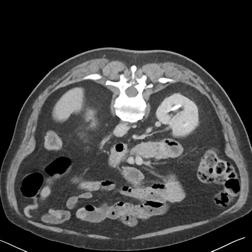 File:Bladder papillary urothelial carcinoma (Radiopaedia 48119-52951 Axial C+ delayed 15).png