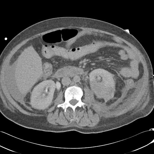 Bladder rupture post renal biopsy (Radiopaedia 30863-31572 Axial non-contrast 42).jpg