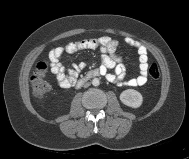 Bleeding duodenal ulcer and adenomyomatosis of gallbladder (Radiopaedia 61834-69861 A 65).jpg