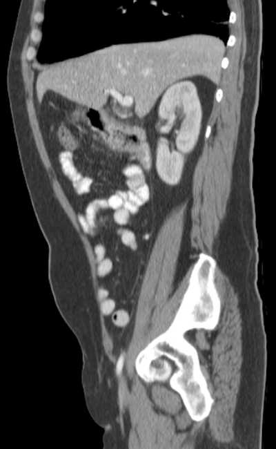 Bleeding duodenal ulcer and adenomyomatosis of gallbladder (Radiopaedia 61834-69861 C 33).jpg