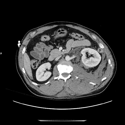 Blunt abdominal trauma with solid organ and musculoskelatal injury with active extravasation (Radiopaedia 68364-77895 A 60).jpg