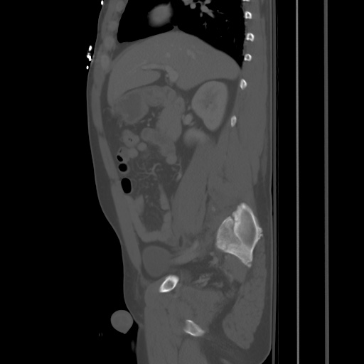 Blunt abdominal trauma with solid organ and musculoskelatal injury with active extravasation (Radiopaedia 68364-77895 Sagittal bone window 34).jpg
