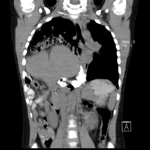 File:Bochdalek diaphragmatic hernia (Radiopaedia 38866-41059 Coronal liver window 12).jpg