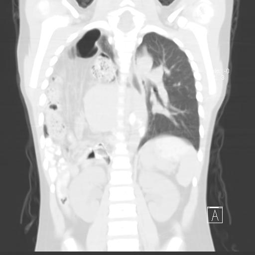 File:Bochdalek diaphragmatic hernia (Radiopaedia 38866-41059 Coronal lung window 14).jpg