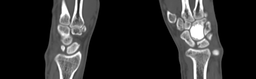 Bone islands - carpus (Radiopaedia 63141-71658 Coronal bone window 31).jpg