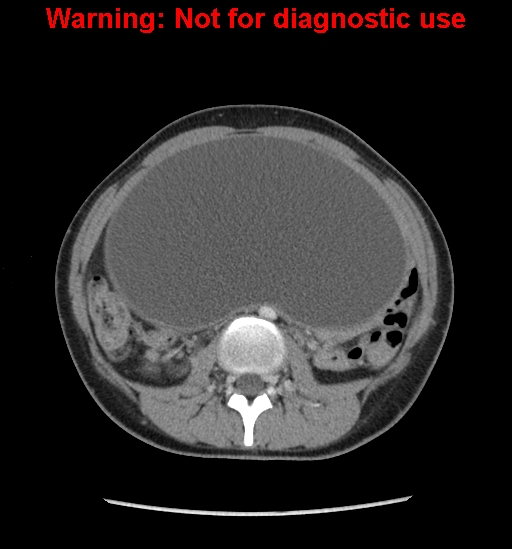 Borderline mucinous cystadenoma of ovary (Radiopaedia 25586-25767 A 25).jpg