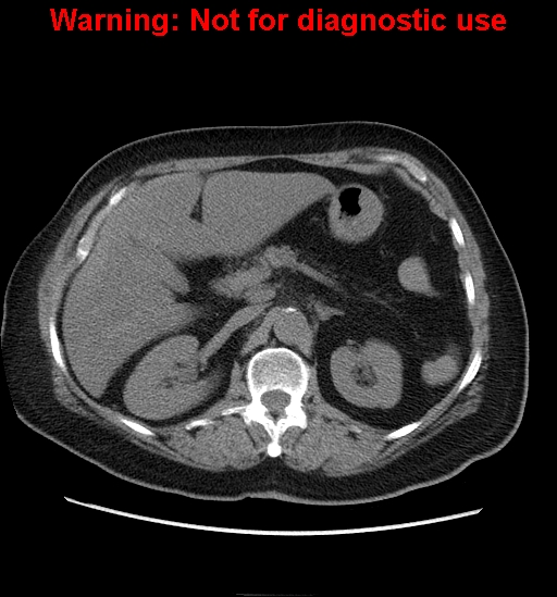 File:Bosniak renal cyst - type II (Radiopaedia 23404-23468 Axial non-contrast 8).jpg