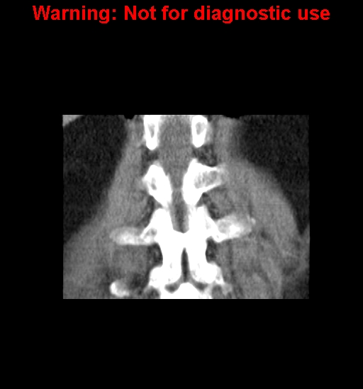 File:Bosniak renal cyst - type IV (Radiopaedia 23402-23466 C 29).jpg