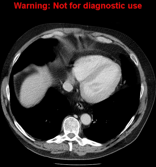 File:Bosniak renal cyst - type IV (Radiopaedia 23402-23466 D 3).jpg