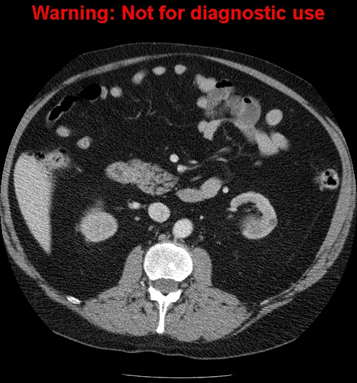 File:Bosniak renal cyst - type IV (Radiopaedia 23402-23466 D 31).jpg