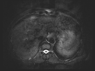 File:Bouveret syndrome (Radiopaedia 61017-68856 Axial MRCP 9).jpg