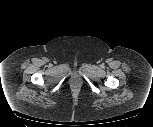Bowel and splenic infarcts in acute lymphocytic leukemia (Radiopaedia 61055-68913 A 132).jpg