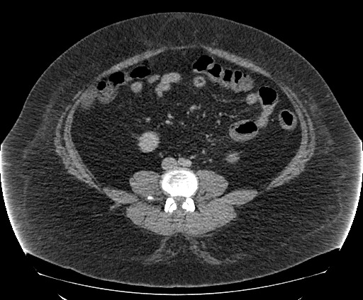 Bowel and splenic infarcts in acute lymphocytic leukemia (Radiopaedia 61055-68913 A 78).jpg