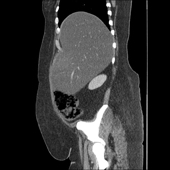 Bowel and splenic infarcts in acute lymphocytic leukemia (Radiopaedia 61055-68915 C 52).jpg