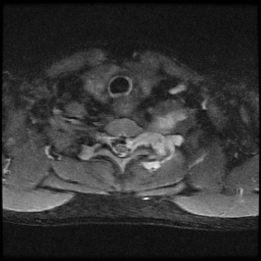 File:Brachial plexus neurofibroma (Radiopaedia 28030-28291 Axial STIR 3).png