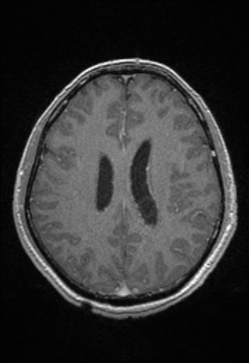 Brain abscess with ventriculitis (Radiopaedia 85703-101495 Axial T1 C+ 116).jpg