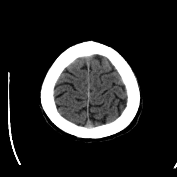 Brain metastases from lung cancer (Radiopaedia 24480-24781 Axial non-contrast 45).jpg