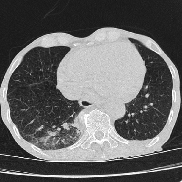 Brain metastases from lung cancer (Radiopaedia 27849-28093 Axial lung window 49).jpg
