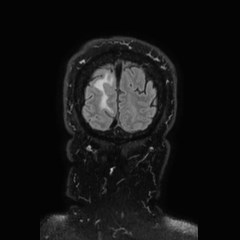 Brain metastases from lung cancer (Radiopaedia 83839-99028 Coronal FLAIR 79).jpg