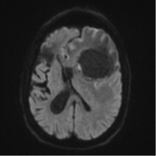 Brain metastasis (lung cancer) (Radiopaedia 48289-53179 Axial DWI 44).png