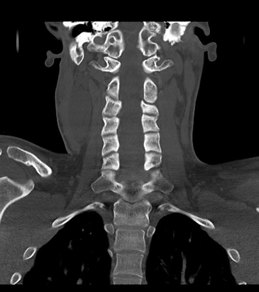 Branchial cleft cyst (Radiopaedia 31167-31875 Coronal bone window 42).jpg