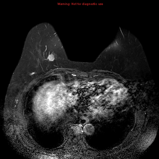 File:Breast carcinoma (multicentric multifocal in mammary Paget disease) (Radiopaedia 50966-56512 Axial T1 C+ fat sat 1).jpg