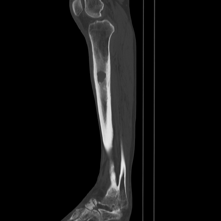 Brodie abscess - tibia (Radiopaedia 66028-75204 Sagittal bone window 39).jpg