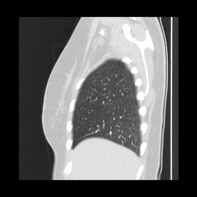 Bronchial atresia (Radiopaedia 22965-22992 Sagittal lung window 47).jpg