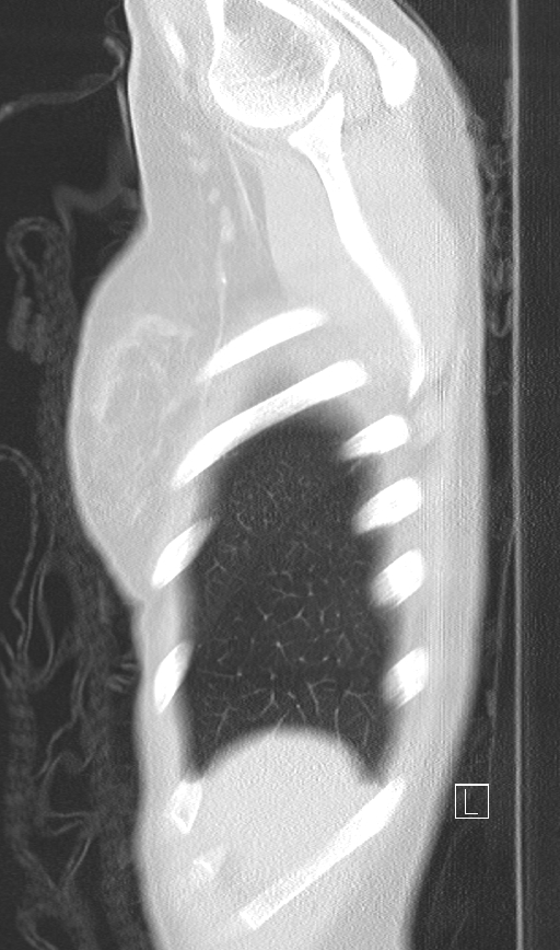 Bronchial atresia (Radiopaedia 73677-84470 Sagittal lung window 4).jpg
