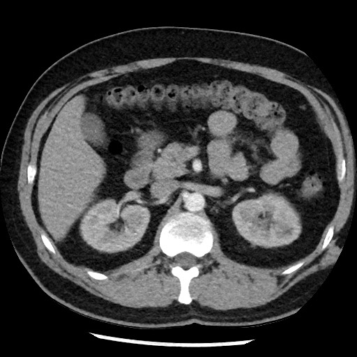 File:Bronchial carcinoid tumor (Radiopaedia 67377-76764 A 70).jpg