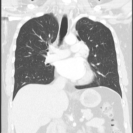 Bronchial carcinoid tumor (Radiopaedia 67377-76764 Coronal lung window 36).jpg