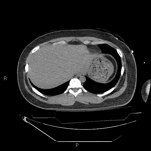 File:Bronchial carcinoid tumor (Radiopaedia 78272-90870 Axial non-contrast 89).jpg
