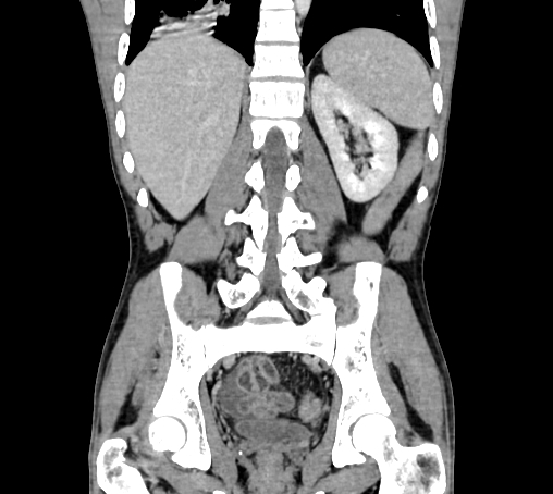 File:Bronchiectasis in Crohn disease (Radiopaedia 60311-67977 C 58).jpg