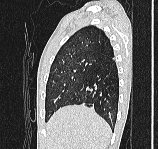 Bronchiolitis obliterans (Radiopaedia 71538-81897 Sagittal lung window 11).jpg