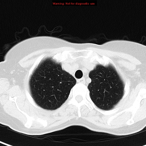 File:Bronchoalveolar carcinoma (BAC) (Radiopaedia 13436-13392 Axial lung window 8).jpg