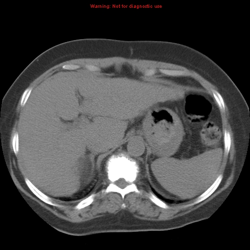 File:Bronchoalveolar carcinoma (Radiopaedia 13224-13233 Axial non-contrast 42).jpg