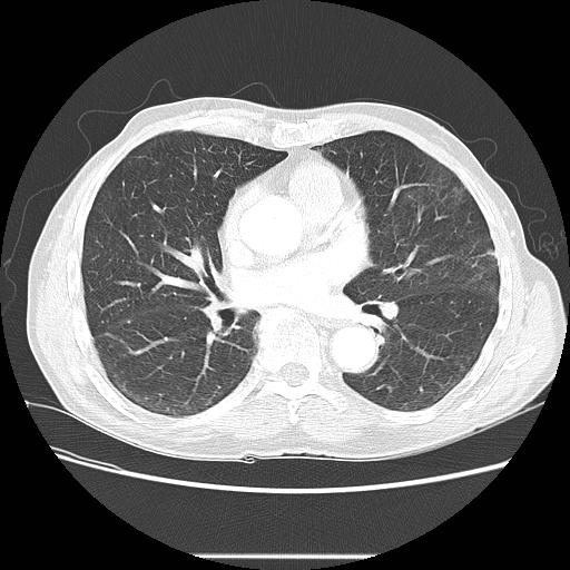 Bronchocele (Radiopaedia 17097-16795 Axial lung window 65).jpg