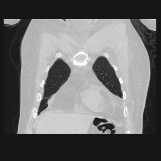 File:Bronchogenic carcinoma with metastatic lymphadenopathy (Radiopaedia 37671-39569 Coronal lung window 9).jpg