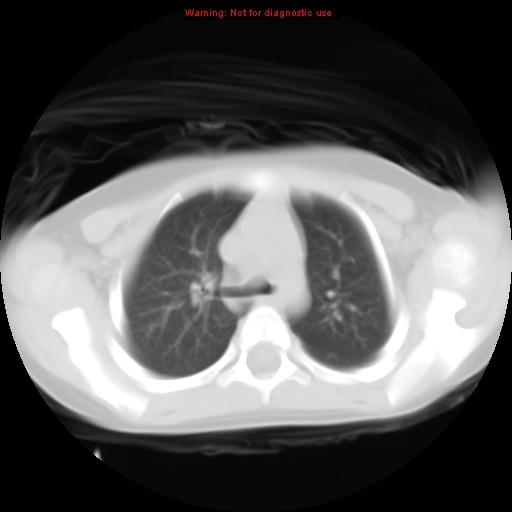 File:Bronchogenic cyst (Radiopaedia 9372-10063 Axial lung window 5).jpg