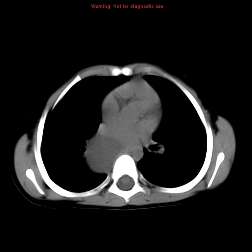 File:Bronchogenic cyst (Radiopaedia 9372-10063 Axial non-contrast 10).jpg