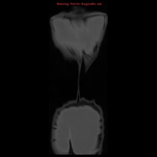 File:Brown tumor (Radiopaedia 12318-12596 D 67).jpg