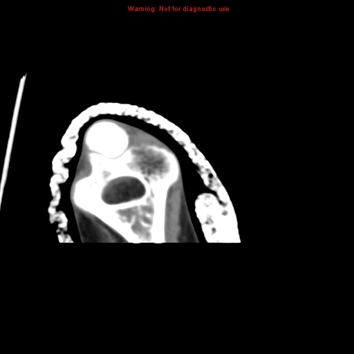 Brown tumor (Radiopaedia 12460-12694 Axial non-contrast 140).jpg