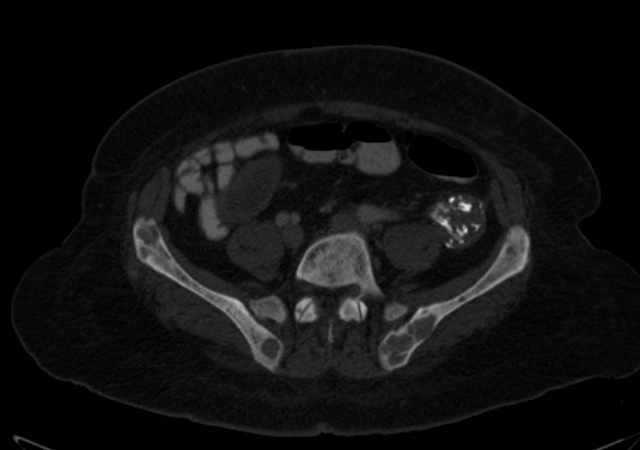 Brown tumors compressing the spinal cord (Radiopaedia 68442-77988 G 88).jpg