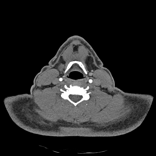 Buccal fat pad arteriovenous malformation (Radiopaedia 70936-81144 D 122).jpg