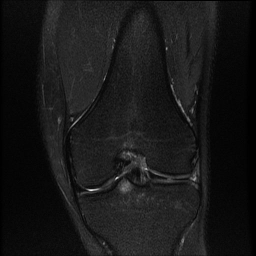 File:Bucket-handle meniscus tear (Radiopaedia 65700-74809 Coronal T2 fat sat 11).jpg