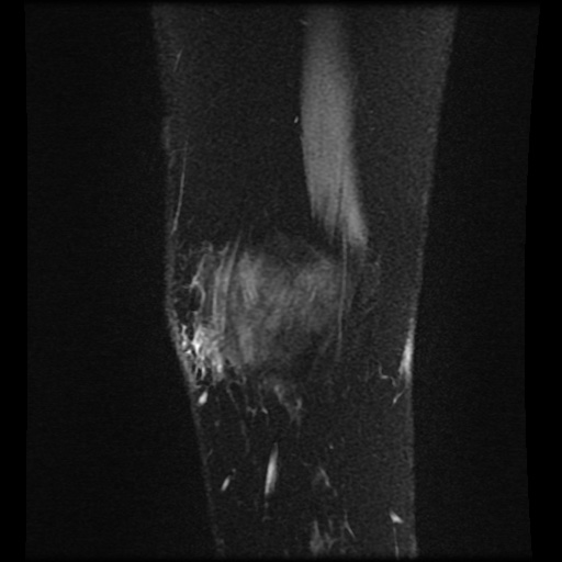 Bucket handle meniscus tear (Radiopaedia 56916-63751 H 81).jpg